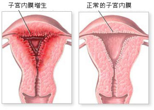 挑戰–子宮內膜增生第四期