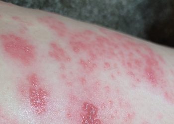 帶狀皰疹中醫的應對方法及原理